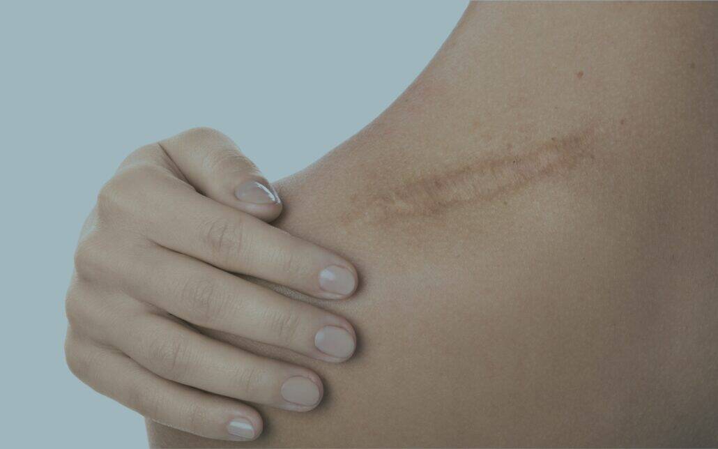 Narbe nach Operation kann chronische Schmerzen verursachen